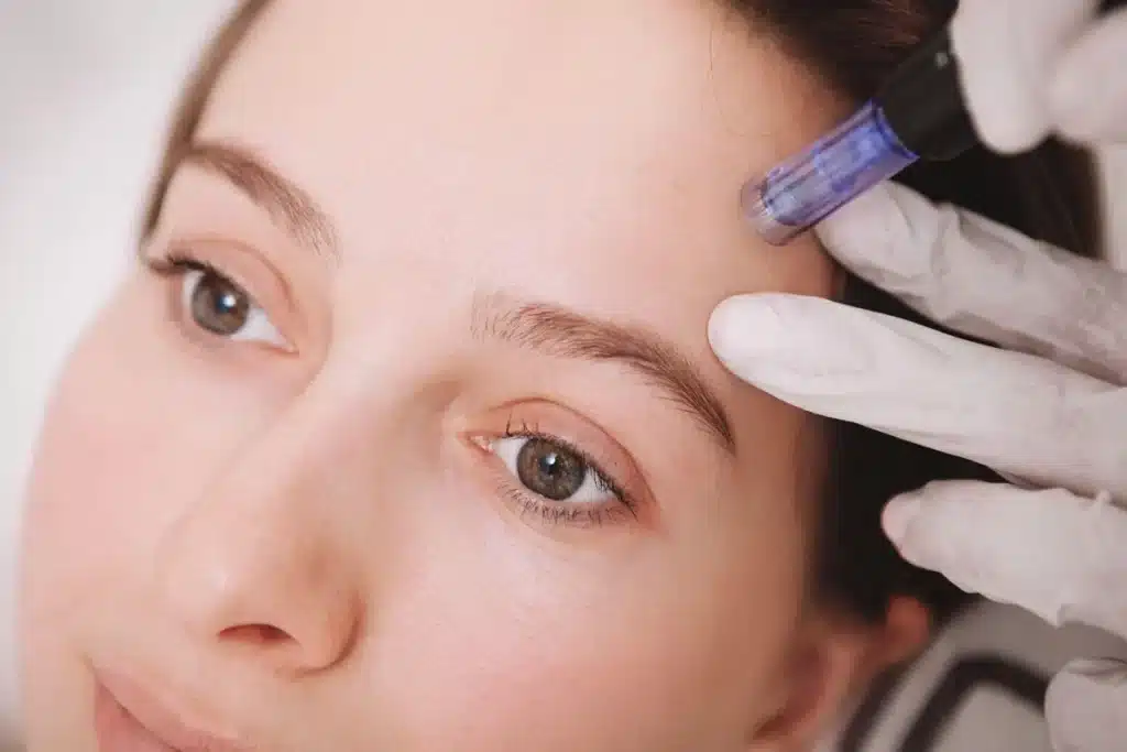 vampire facial microneedling Las Vegas PRP skin rejuvenation