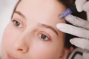 Vampire Facial® / Micro-Needling