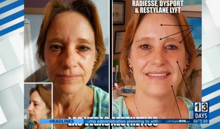 CBS News Las Vegas before and after Dysport, Restylane Lyft, and Radiesse treatment — dramatic facial rejuvenation with annotated results at Las Vegas Aesthetics by Thomas Pulice PA-C
