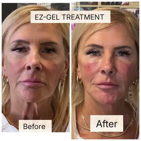 EZ Gel PRF facial rejuvenation before and after Las Vegas — immediate results showing lifted midface and restored volume at Las Vegas Aesthetics by Thomas Pulice PA-C
