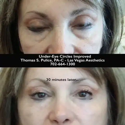 EZ Gel PRF under eye circles before and after Las Vegas — visible improvement in 30 minutes at Las Vegas Aesthetics by Thomas Pulice PA-C