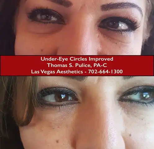 EZ Gel PRF under eye circles before and after Las Vegas — dark circles and hollowing improved with PRF at Las Vegas Aesthetics by Thomas Pulice PA-C