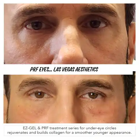 EZ Gel PRF under eye treatment before and after Las Vegas — male under-eye circles and hollowing treated with PRF biostimulator at Las Vegas Aesthetics by Thomas Pulice PA-C