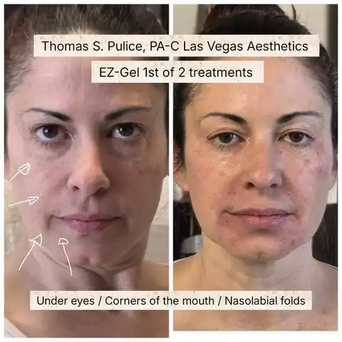 EZ Gel PRF before and after Las Vegas — under eye hollowing, nasolabial folds, and mouth corners treated with PRF biostimulator at Las Vegas Aesthetics by Thomas Pulice PA-C