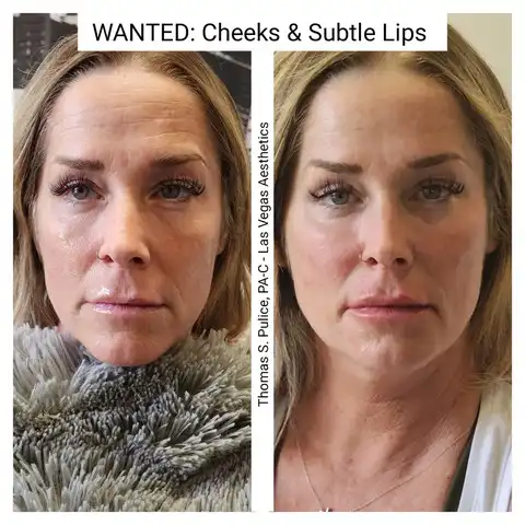 Restylane cheek and lip filler before and after Las Vegas — subtle lip enhancement and cheek volume restoration at Las Vegas Aesthetics by Thomas Pulice PA-C