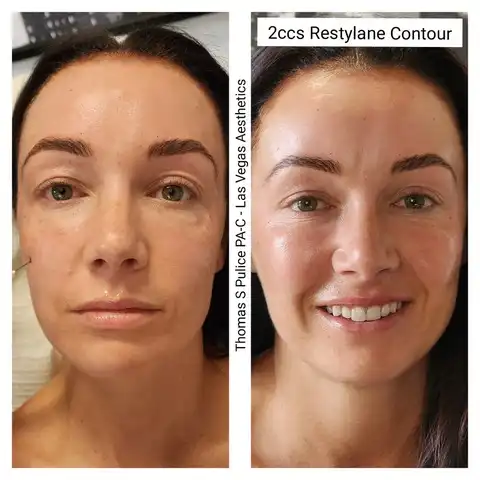 Restylane Contour cheek filler before and after Las Vegas — 2cc cheek contouring and midface volume at Las Vegas Aesthetics by Thomas Pulice PA-C