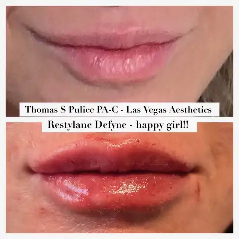 Restylane Defyne lip filler before and after Las Vegas — dramatic natural lip volume and definition at Las Vegas Aesthetics by Thomas Pulice PA-C