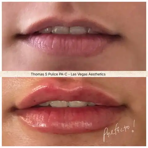 Restylane lip filler close-up before and after Las Vegas — natural lip volume and definition results at Las Vegas Aesthetics by Thomas Pulice PA-C