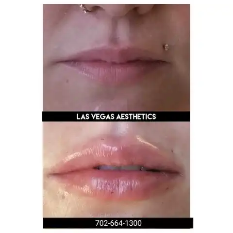 Restylane lip filler before and after Las Vegas — natural lip volume and fullness results at Las Vegas Aesthetics by Thomas Pulice PA-C