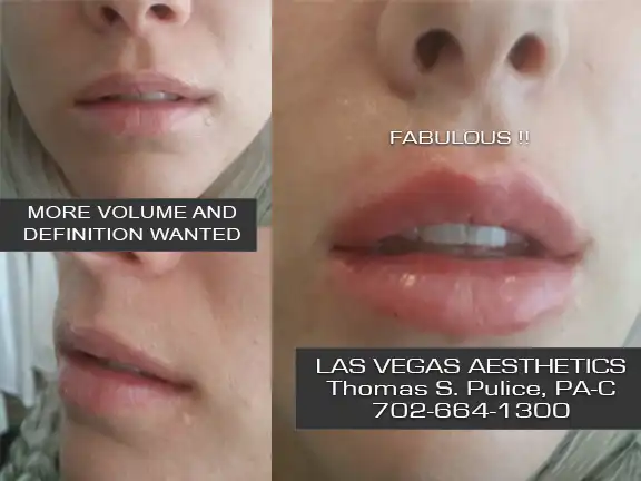 Restylane lip filler before and after Las Vegas — more volume and definition results at Las Vegas Aesthetics by Thomas Pulice PA-C