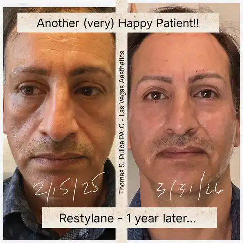 Restylane male dermal filler before and after Las Vegas — 1 year results showing facial volume restoration and natural rejuvenation for men at Las Vegas Aesthetics by Thomas Pulice PA-C