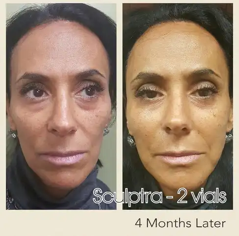 Sculptra 2 vials before and after 4 months Las Vegas — gradual collagen stimulation results at Las Vegas Aesthetics by Thomas Pulice PA-C