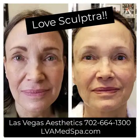 Sculptra collagen stimulator before and after Las Vegas — natural volume and collagen restoration at Las Vegas Aesthetics by Thomas Pulice PA-C