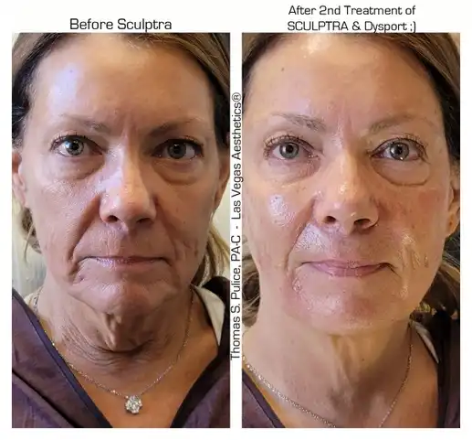 Sculptra and Dysport combination before and after Las Vegas — second treatment results showing lifted and refreshed appearance at Las Vegas Aesthetics by Thomas Pulice PA-C
