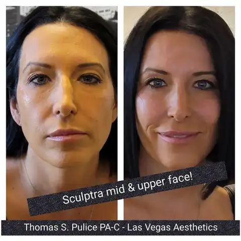 Sculptra mid and upper face before and after Las Vegas — collagen stimulation for temples cheeks and upper face at Las Vegas Aesthetics by Thomas Pulice PA-C