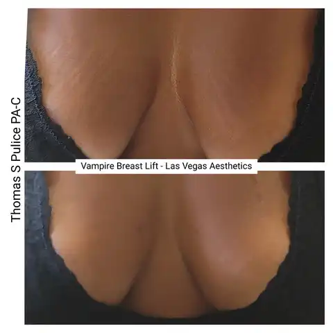 Vampire Breast Lift before and after decolletage Las Vegas — skin texture and breast contour improvement with PRP at Las Vegas Aesthetics