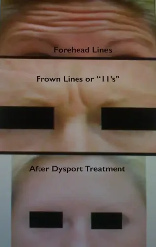 Dysport treatment before and after Las Vegas — forehead lines and frown lines (11s) eliminated at Las Vegas Aesthetics by Thomas Pulice PA-C